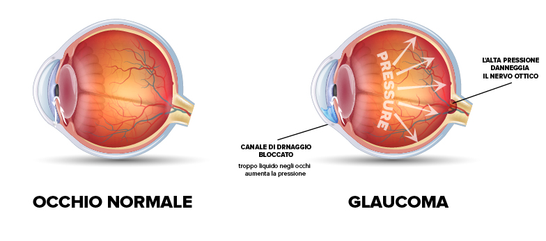 Glaucoma